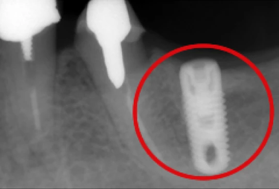 インプラントの埋め込み