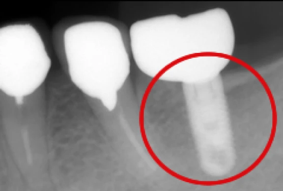 上部構造の装着