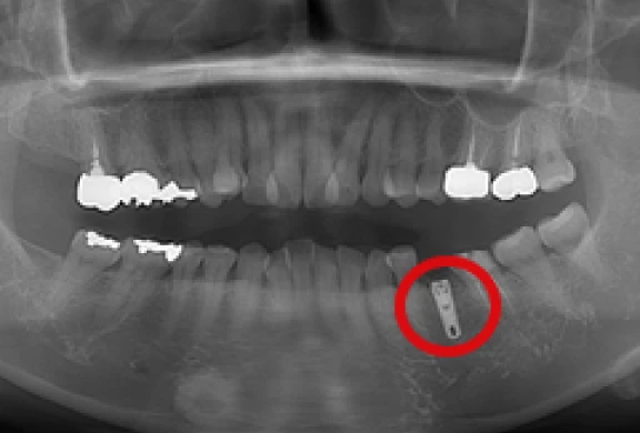 歯間部のインプラント