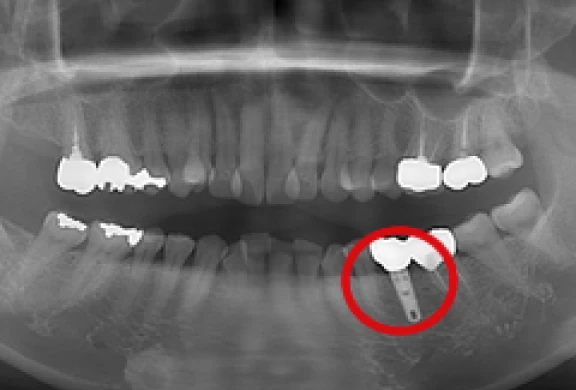 歯間部のインプラント(上部構造の装着)