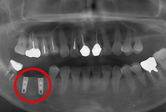 歯間部のインプラント(2本)