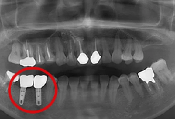歯間部のインプラント（2本、上部構造の装着）