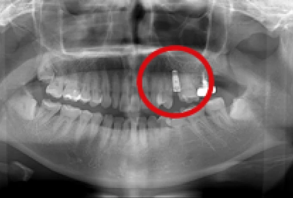 上顎のインプラント